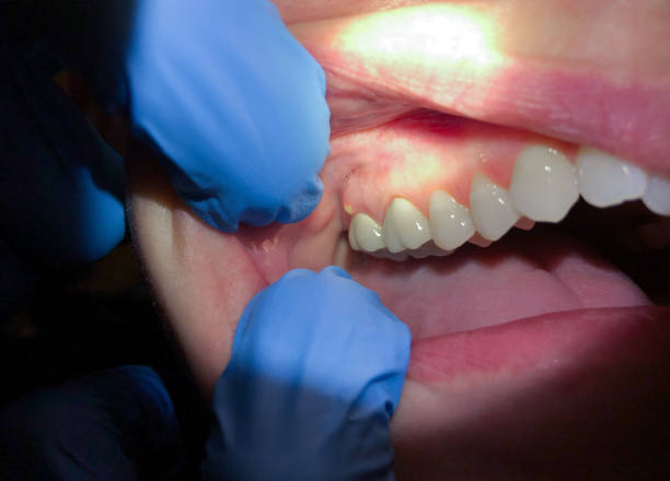 Best Emergency Gum Pain Relief  in Taylor Creek, OH